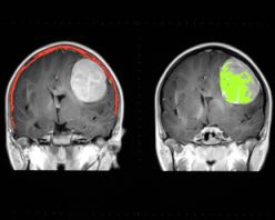 Brain Tumor scan